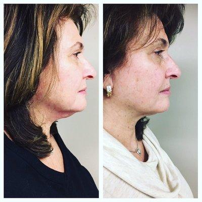 Amazing Kybella (double chin treatment) Pre treatment and 6 weeks after first treatment.