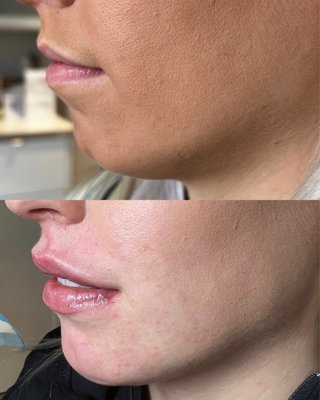 Lip & chin filler for facial balancing