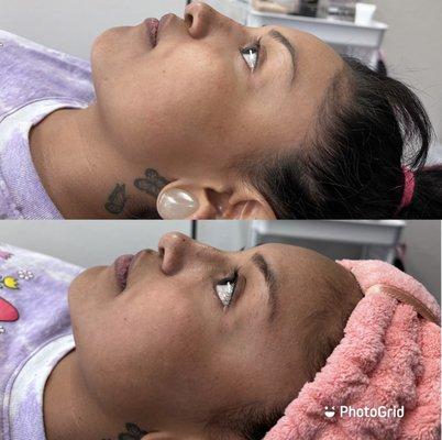 Dermaplane Facial