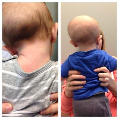 Another example of chiropractic helping to resolve torticollis.  This baby was midway through his care and already seeing ama...