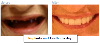 Implants and Teeth in a day