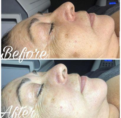 Anti-aging and Chemical Peel