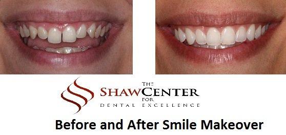 Smile Makeover with Simple Procedures!