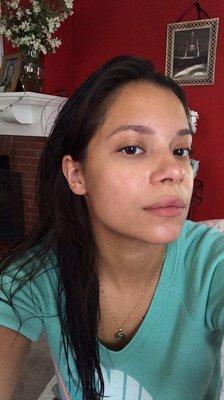 No makeup. Day after microdermabrasion from Jade Medispa