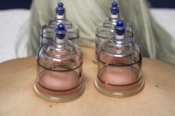 Cupping