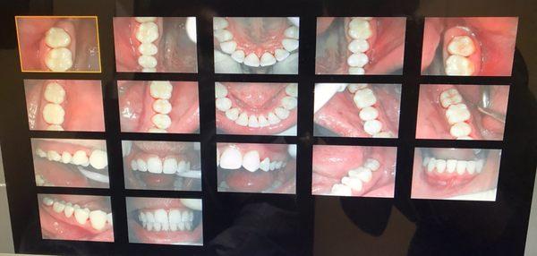 My teeth after (cavities taken care of, stains removed and plaque removed) I am over the MOON!