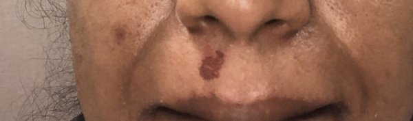 Skin burnt /peeled during my upper lip waxing