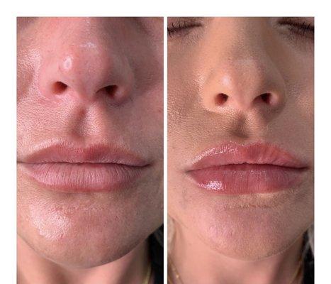 Natural plump using Juvederm Ultra XC Lip Filler