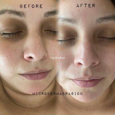 Before and after microdermabrasion  (look at the nose and eyes)