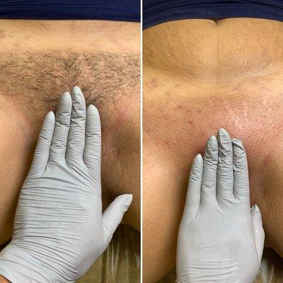 Brazilian Wax Before & After