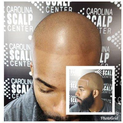 Scalp Micropigmentation gave this young man his youthful appearance back.