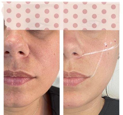 Dermal fillers for lift and contour