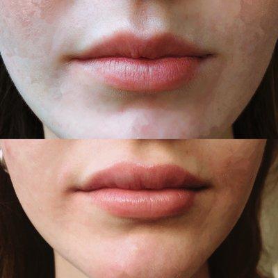 Before and after of lip plumping with filler