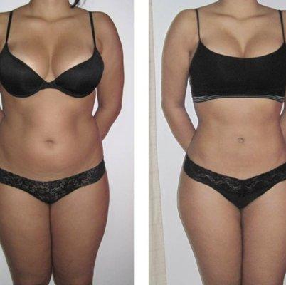 Before and after real results from using a series of UltraSlim technology for fat loss and skin tightening