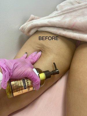 Cellulite cavitation!