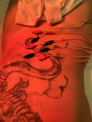 Electro acupuncture