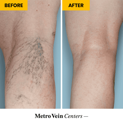 Before and after: spider vein removal results. We offer a variety of FDA-approved spider vein treatments, including vein laser!