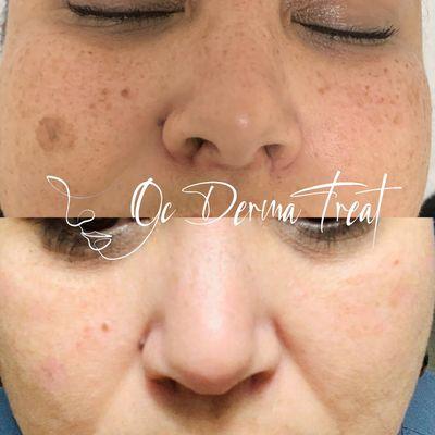 Treat Hyperpigmentation, Melasma, Rosacea,Acne Scarring, sunspots and aging spot removal