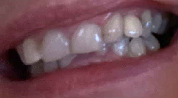 Discolored tooth, not matching others. 10 appointments and still not right.