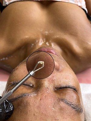 Extractions included in every facial