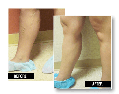 Healthy legs after vein treatment