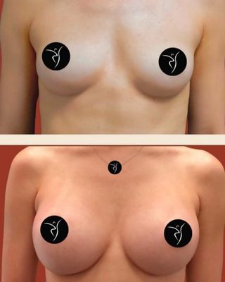 Breast Augmentation