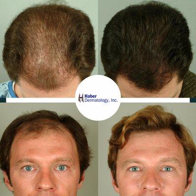 Incredible hair transplant results