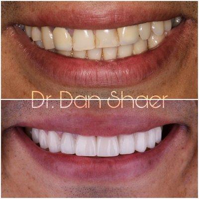 Smile makeover & correction of a canted smile