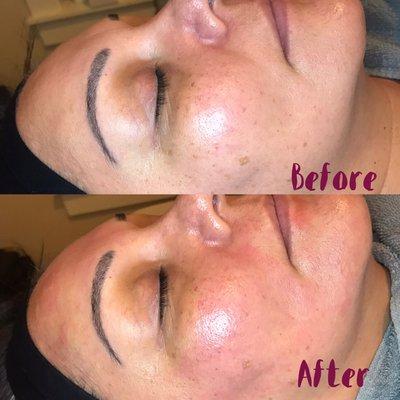 Microneedling Before and After