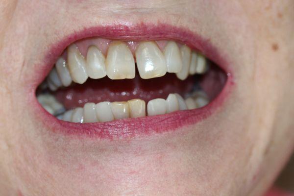 Gap between the teeth on the upper and lower. Upper center teeth are not symmetrical.