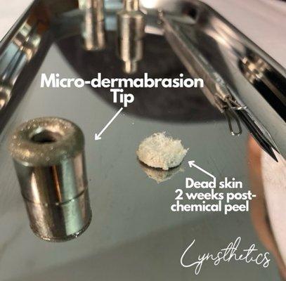 Microdermabrasion- exfoliation