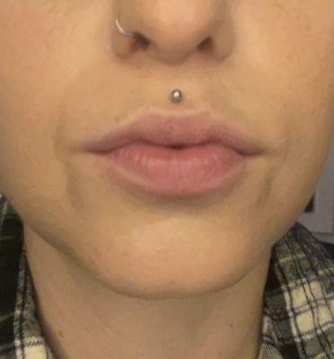 6 days post treatment, no make up