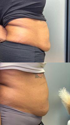 1 round of mesotherapy/lipo dissolve