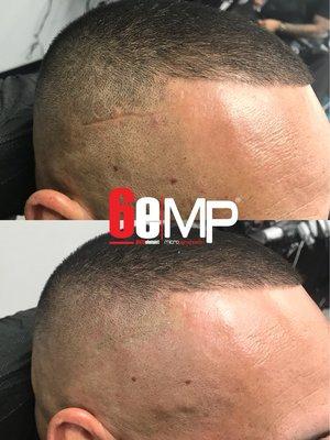 We can camouflage any unwanted scars from accidents to hair transplant scars.