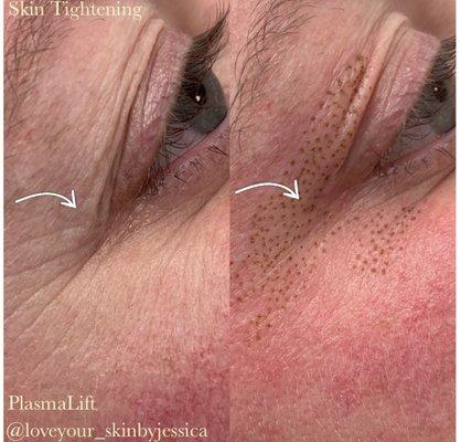 PlasmaLift Skin Tightening