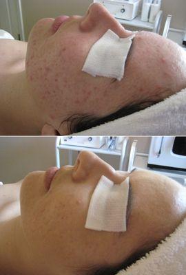 Before & After Curative Acne Facial with Floracide Peel