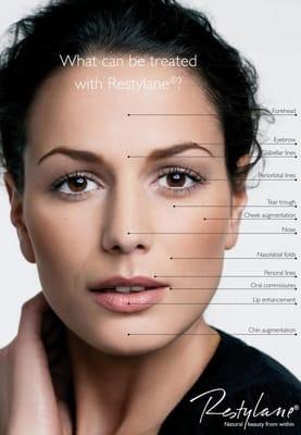 What can be treated with Restylane?