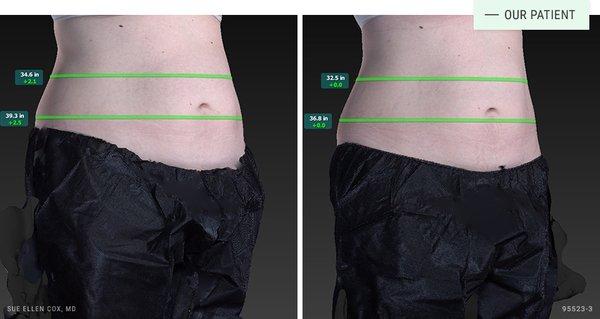 CoolSculpting for the abdomen