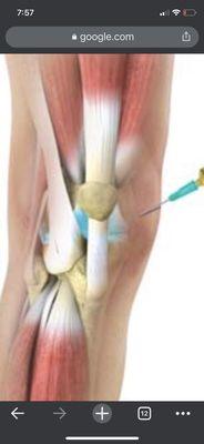 PRP injections to help with osteoarthritis and painful joints.