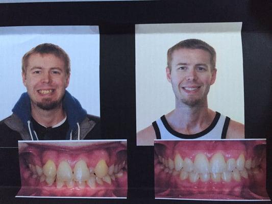 Unbelievable results from 2 YEARS of treatment. Advanced Orthodontics Specialists are basically miracle workers.