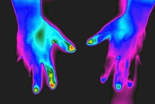 Detection of gout in hands with thermography and not radiation