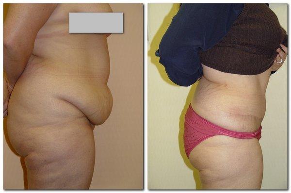 This young woman is shown before and 3 months after a tummy tuck. The abdominal muscles were tightened and the extra skin was removed.$9000