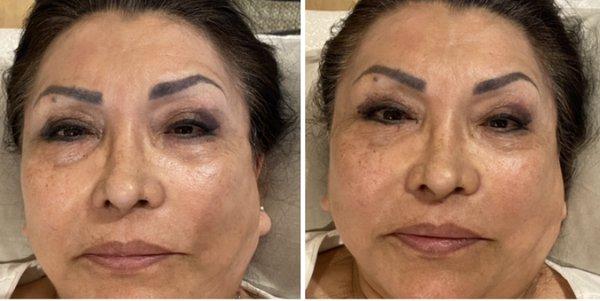 Energetic Facelift after first session