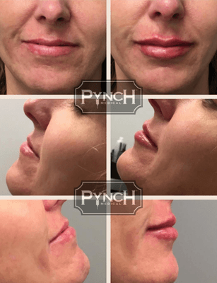 PYNCH Medical North Scottsdale Lip Plump