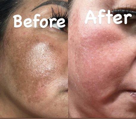 Melasma progress