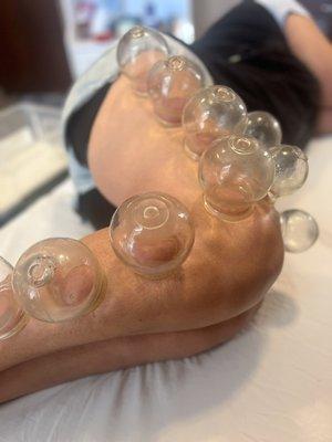 Cupping, leg and knee pain