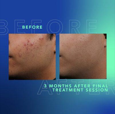 Drug-free clearance that lasts.
All skin types
All acne severities
All in 30-minute treatment sessions