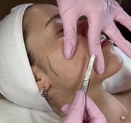 Dermaplane facial