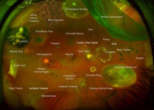 Optomap is a non-invasive procedure allows your doctor to see a much broader and more detailed view of the retina.