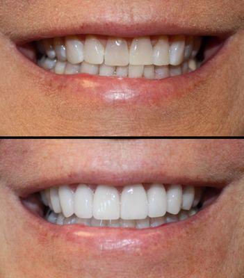 Veneers and Crowns